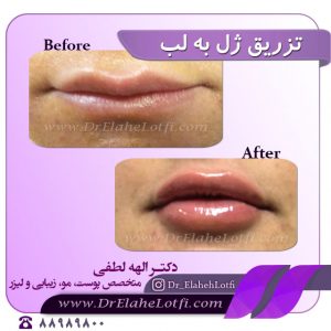 تزریق ژل به لب