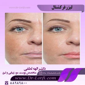 لیزر-فرکشنال