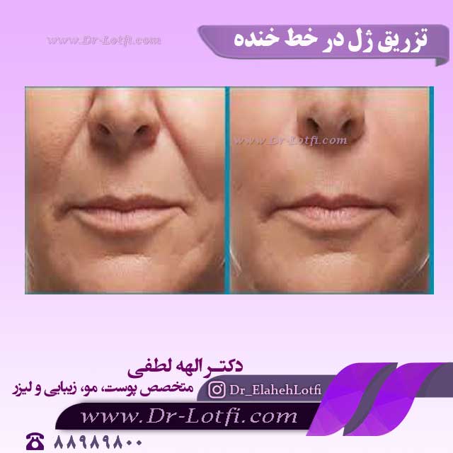 تزریق ژل در خط خنده