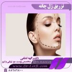 تزریق-ژل-چانه