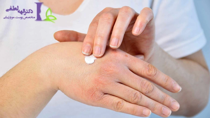 درمان اگزما پوست