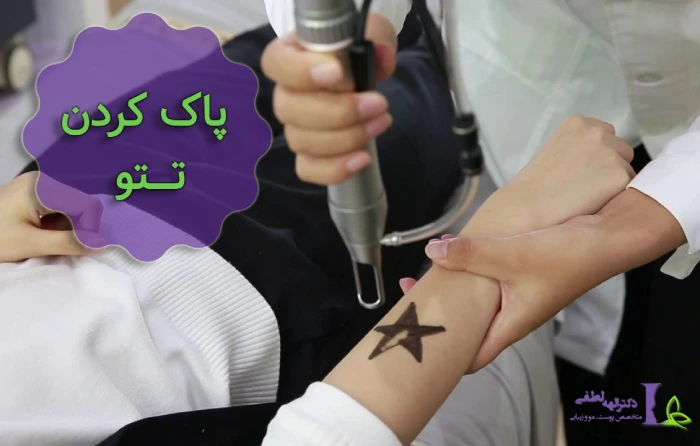 ریموو تاتو قدیمی