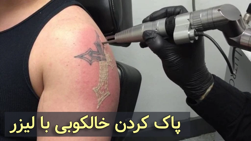 پاک کردن خالکوبی با لیزر