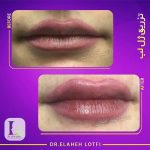 تزریق ژل لب