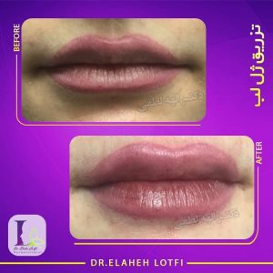 تزریق ژل لب