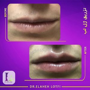 تزریق ژل لب