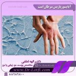 پسوریازیس