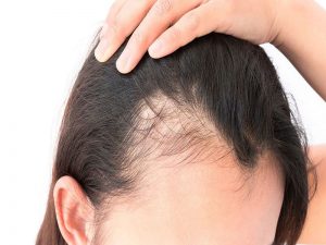 درمان ریزش مو(آندروژنتیک)
