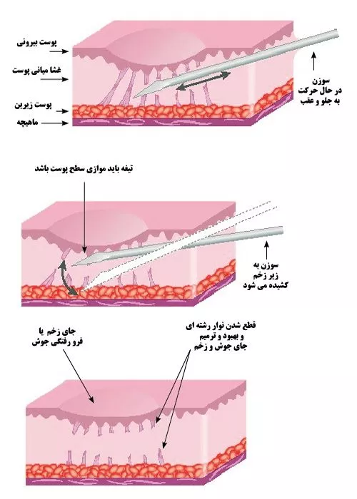 مراحل-انجام-سابسیژن