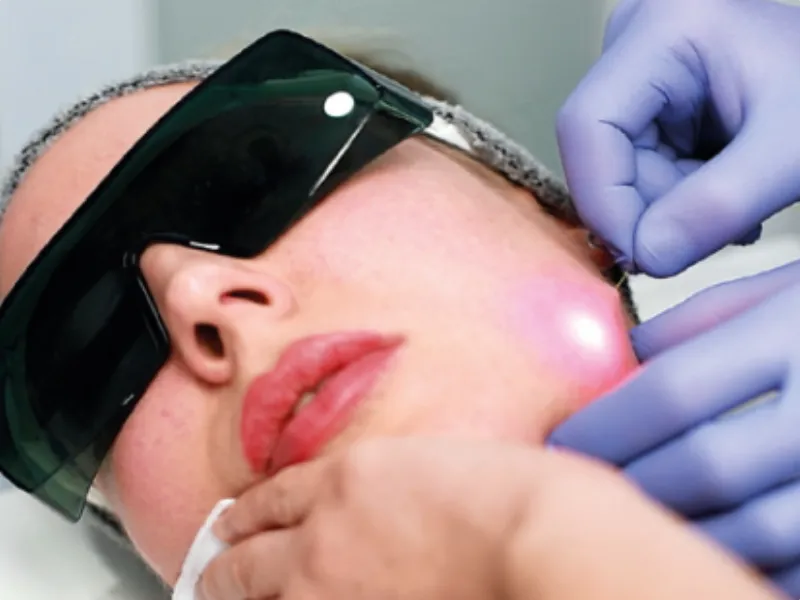 اندولفیت برای جای جوش