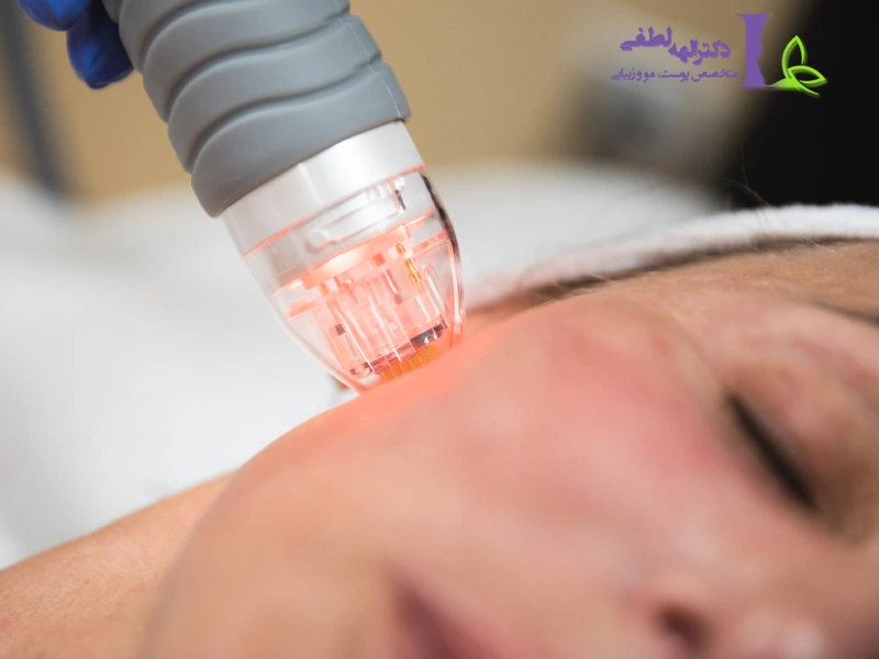 مراقبت‌های قبل و بعد از آر اف فرکشنال