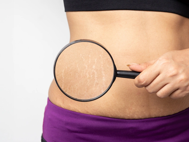 درمان ترک پوستی