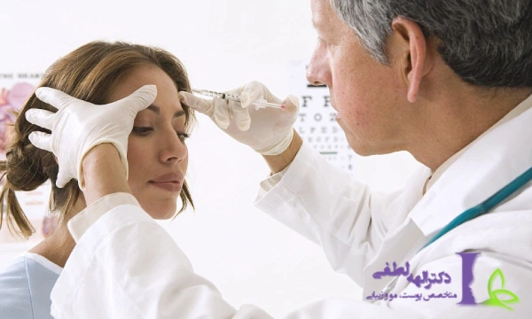 نقاط تزریق بوتاکس برای میگرن