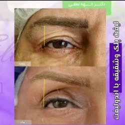 اندولیفت پلک و شقیقه
