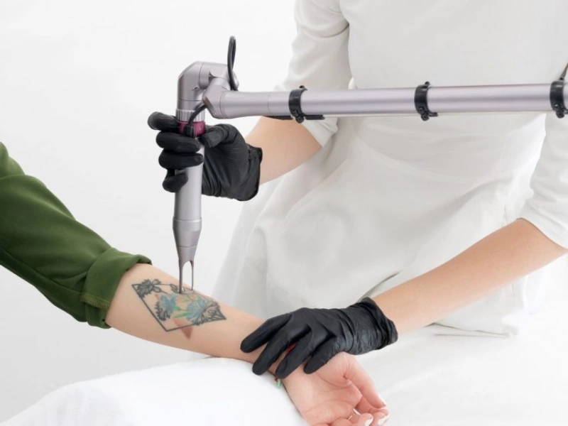 لیزر پیکولو(PicoLO)