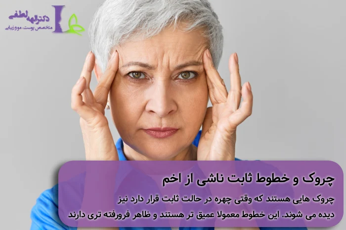 بوتاکس خط اخم