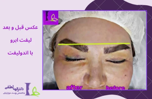عکس قبل و بعد اندولیفت