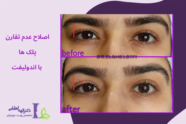هزینه اندولیفت پلک