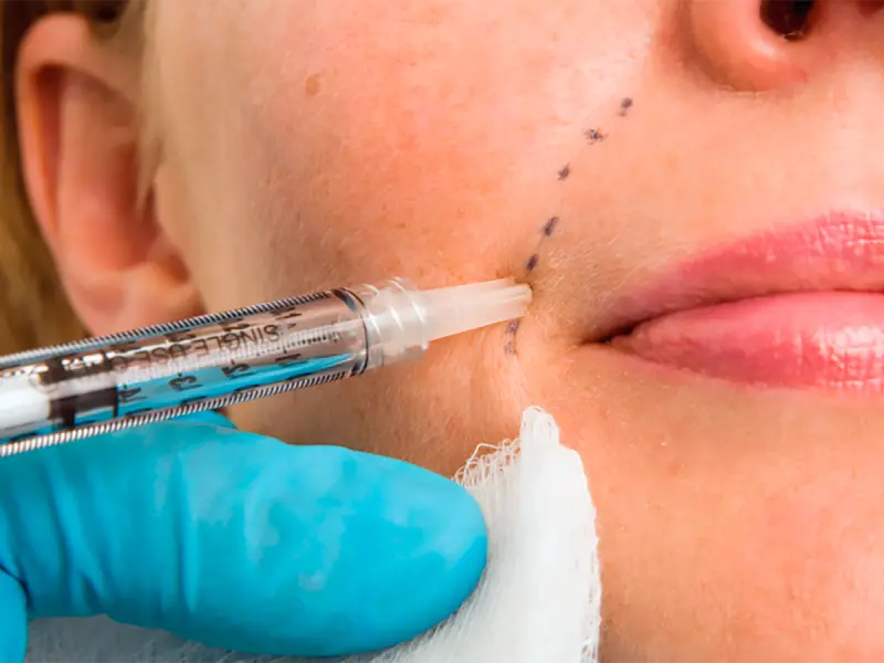 تزریق فیلر بعد از اندولیفت