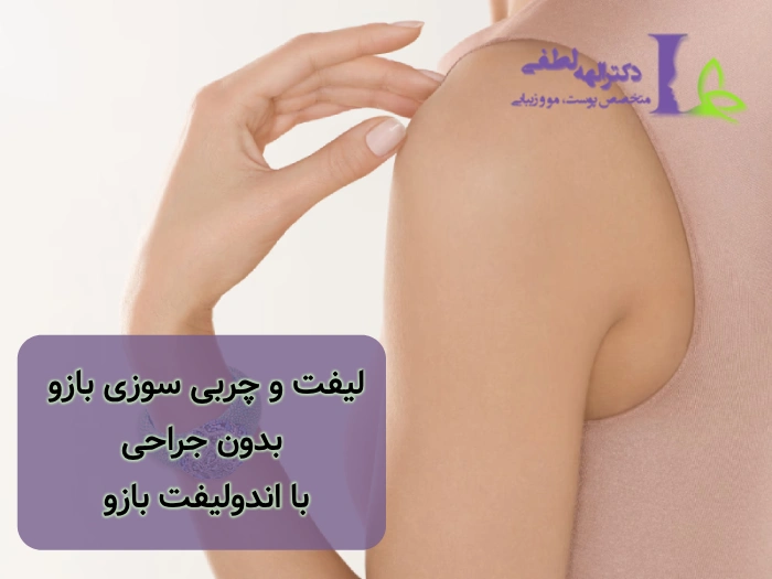 اندولیفت بازو