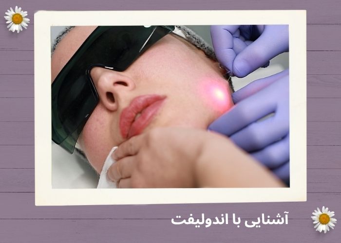 جوانسازی با روش اندولیفت