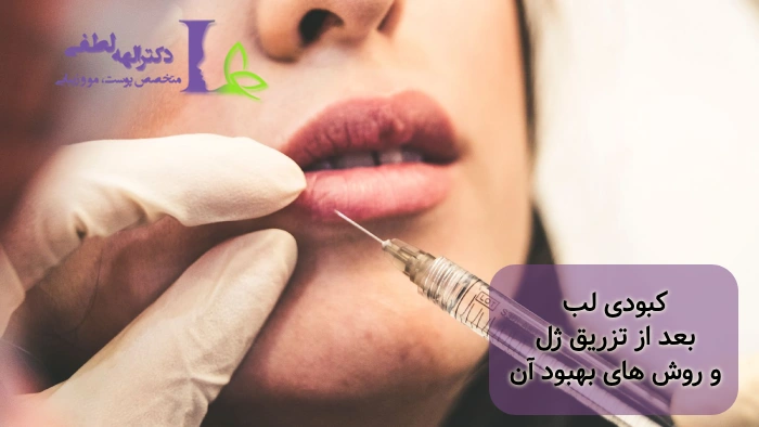 رفع کبودی لب بعد از تزریق ژل