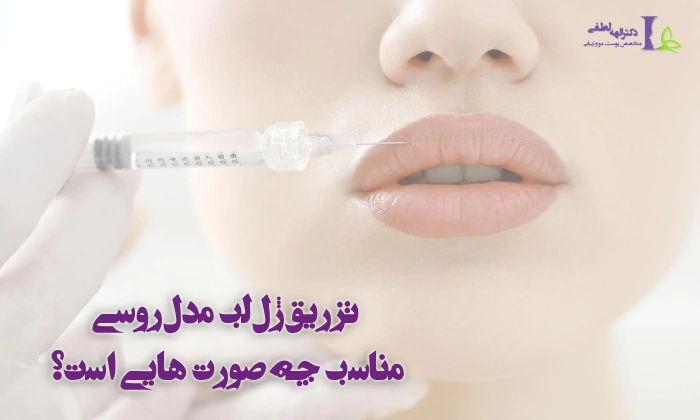 تزریق ژل لب مدل روسی