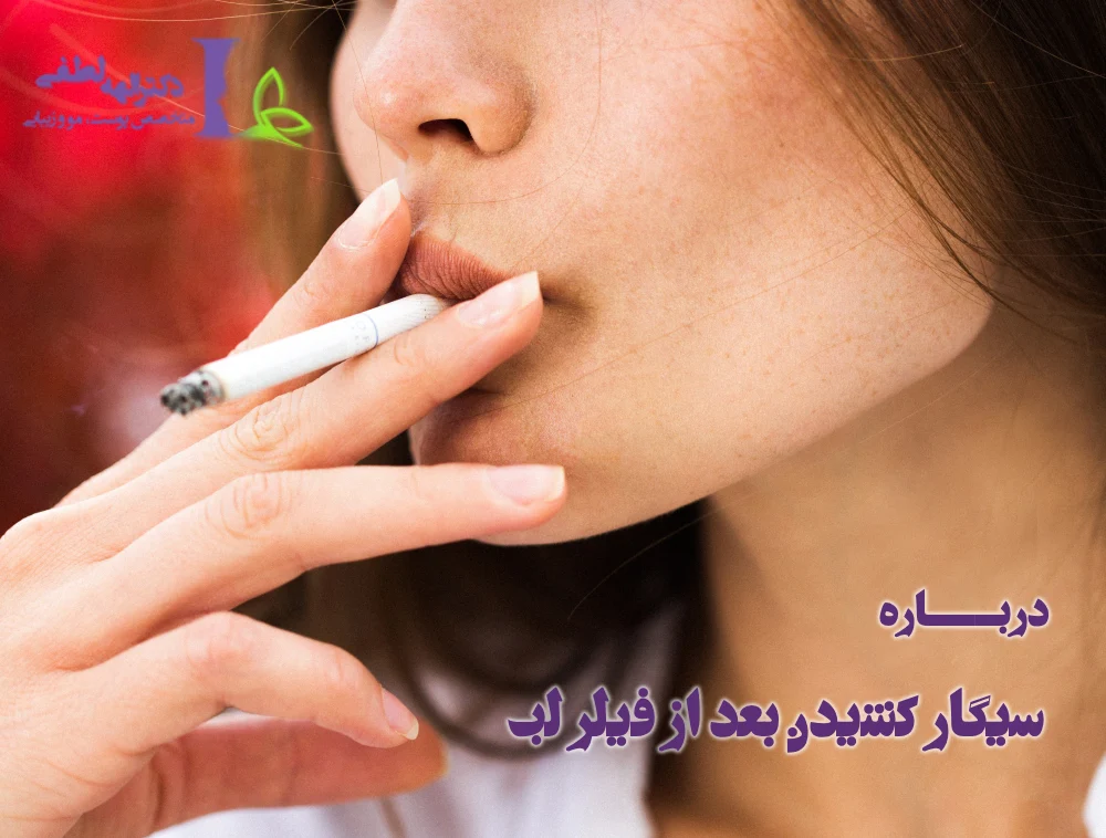 سیگار کشیدن بعد از تزریق فیلر لب