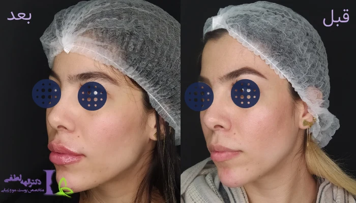 عکس قبل و بعد تزریق ژل لب