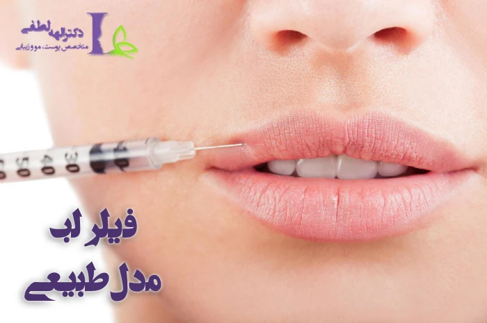 تزریق ژل لب مدل طبیعی