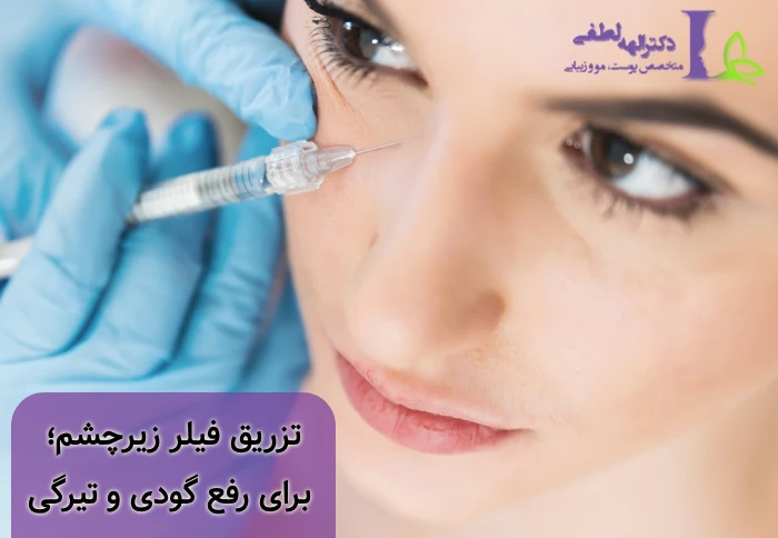 تزریق فیلر زیرچشم